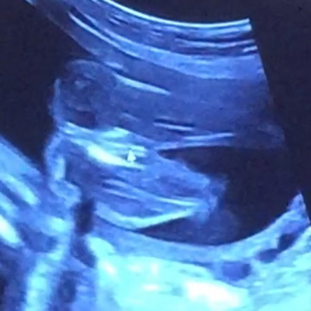 Gambar scan baby boy ke girl