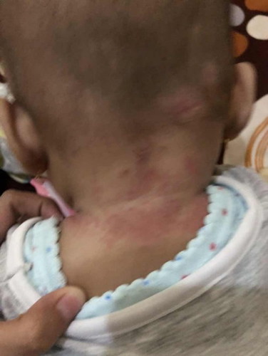Jamur pada kulit bayi