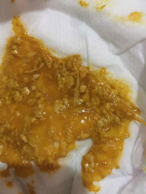 Bé đi ngoài phân lạ