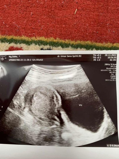 Kantong janin masih sangat kecil