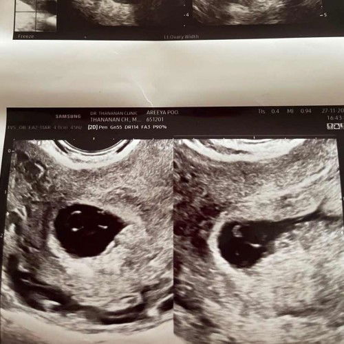 สอบถามหน่อยค่ะแบบนี้ท้องลมมั๊ยคะ หมอซาวด์เจอถุงไข่แดง2ใบ แต่ไม่เจอตัวน้อง