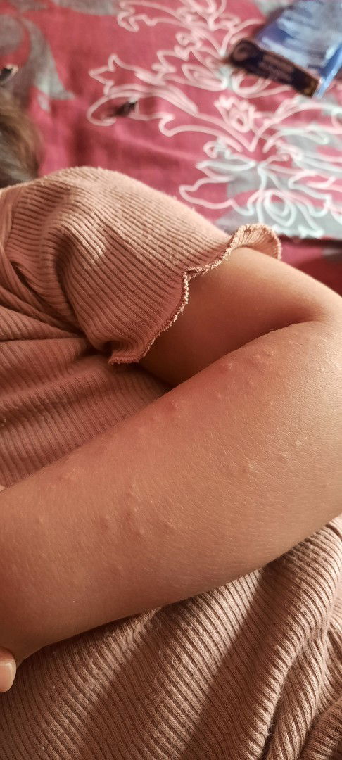 Bintik² pada tangan anak