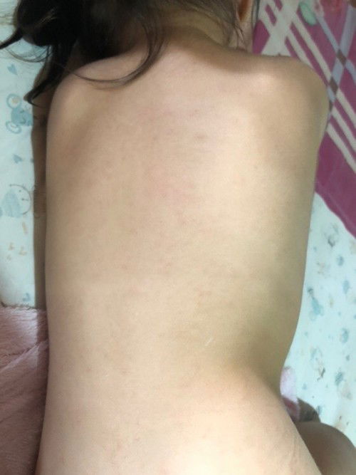 น้อง 2 ขวบ มีตุ่มเหมือนผื่น