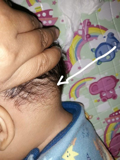 Tulang kepala blakang sebelah kiri lebih menonjol tp keras tidak bergerak.kenapa ya?