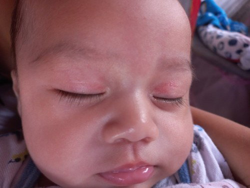 Hello mga mamsh tanong lang po kung normal lang yung redness sa eyelid ni baby? Thank you po!