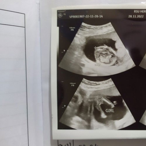 Bismillah.. Hasil USG 16 minggu-ku