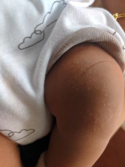 Bintik bintik pada bayi usia 1bulan