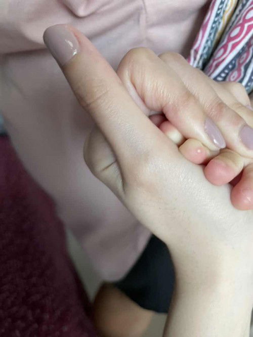 Whiteheads on baby finger