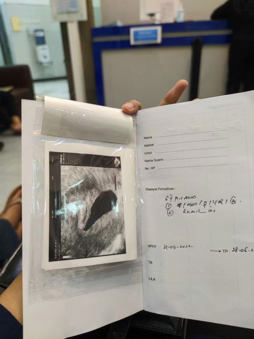 Hamil BO apa harus segera kuret?