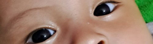 Strabismus atau mata juling bayi