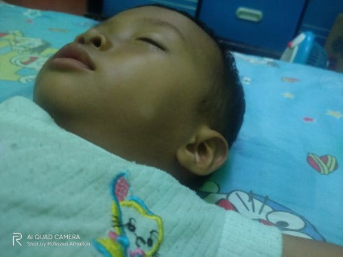 Cara menghilangkan putih2 di muka