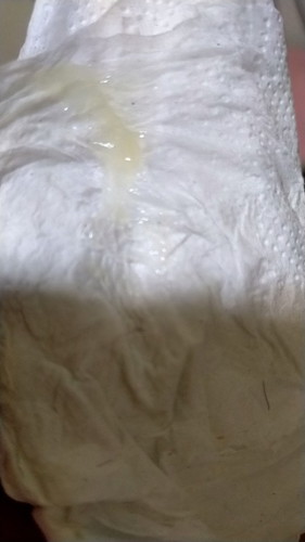 มีมูกสีขาวข้นเหนียว 35 วีค ท้องปั้นแข็งแล้วคลาย ควรไปหาหมอไหมค่ะ