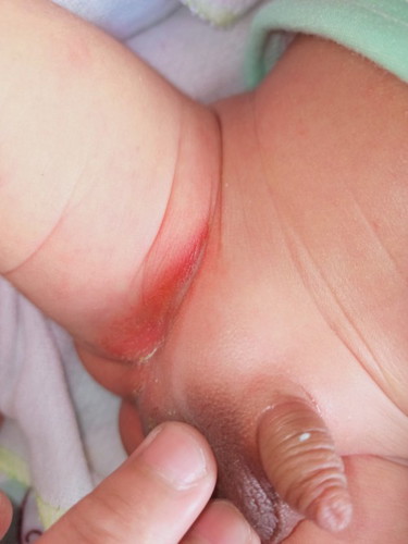 ano pong gamot sa pilas n baby?first time mom hindi ko po alam ano ilagay sa pilas sa singit at leeg