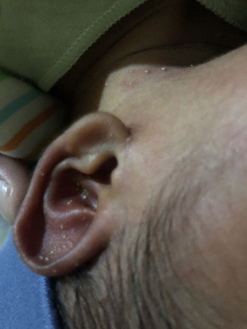 Bintik bintik putih di wajah bayi