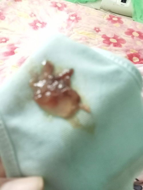 มีมูกออกแบบนี้ปกติไหมคะแม่ๆโดนกระตุ้นปากหมดลูกไปเมื่อวาน 37+6week