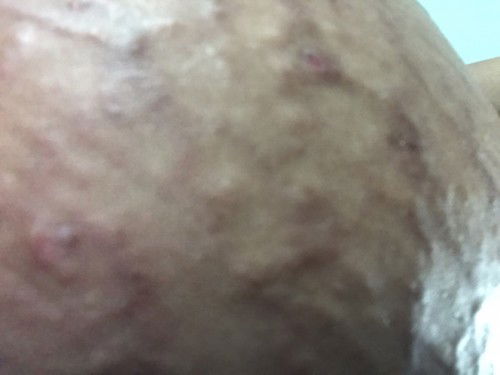 อาการครรภ์เป็นพิษหรือผื่นครรภ์ฮอโมนคะ