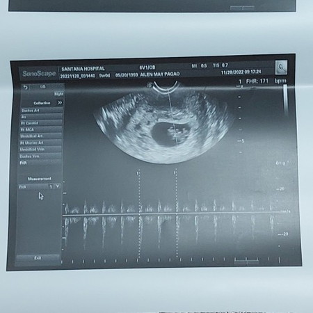 8 weeks transv ultrasound, normal po ba heart rate ni baby 171 bpm?