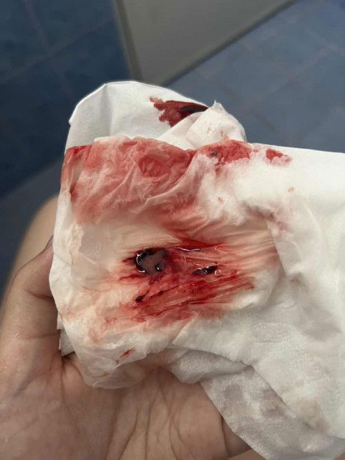 เลือดไหลจากช่องคลอด