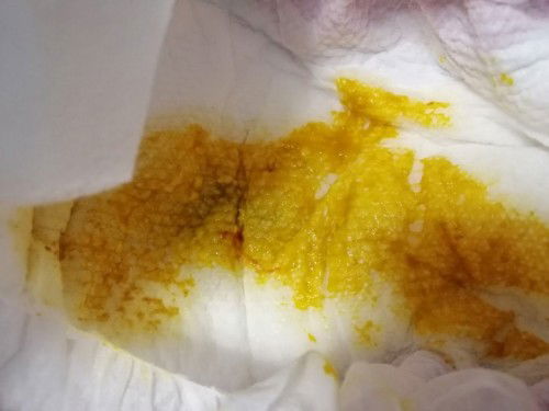 Breastfed baby poop