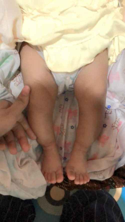 Bayi 1 bulan kakinya bentuk O