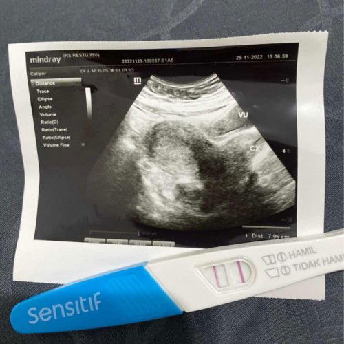 Penebalan dinding rahim hpht 28 oktober 2022