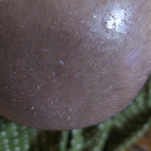 Kulit kepala mengelupas