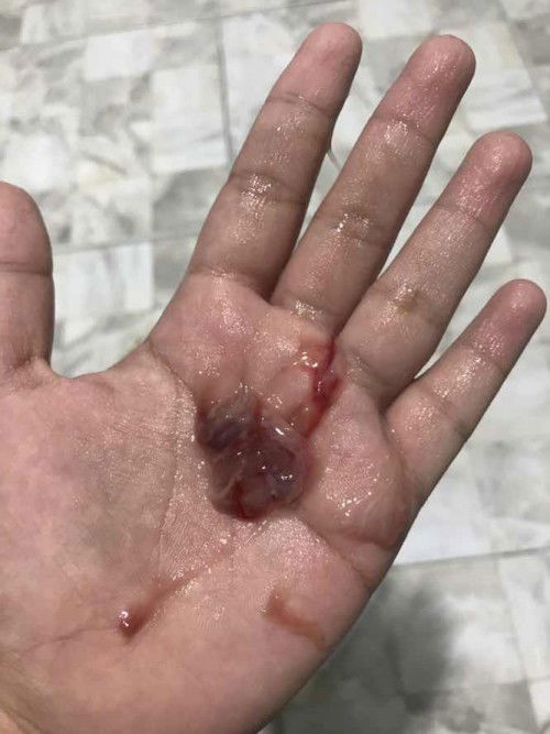 วันนี้ไปกระตุ้นการคลอดมา แล้วช่วงเย็นมีแบบนี่ออกมา ต้องไปรพ.มั้ยคะ