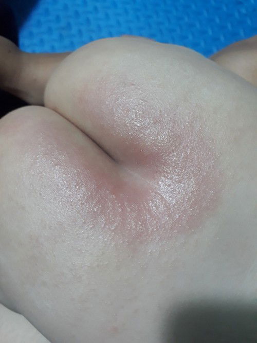 Bé nhà mình 2 ngày hôm nay cứ đi vệ sinh nặng là mông của bé lại như vậy