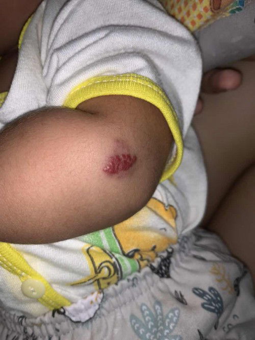 Tanda merah di lengan