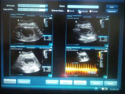 Hasil usg janin