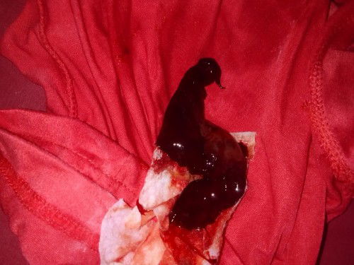 รกเกาะต่ำ เลือดออกเป๋นก้อนเป๋นแบบนี้แต่ไม่มีอาการปวดท้องจ้า มีแม่ๆในกลุ่มใครประสพเรื่องราวแบบนี้บ้าง