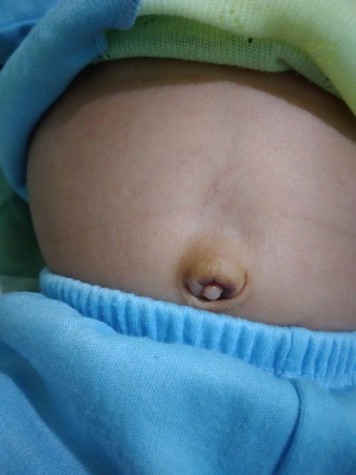 Anak 1 bulan 3 hari. Wajar ga sii bun pusarnya kaya gini. Worry banget 😭😭😭😭😭😭😭😭😭😭😭😭😭😭