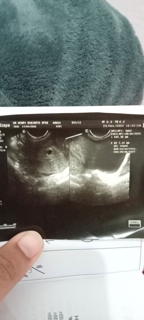 Keluar darah apakah keguguran