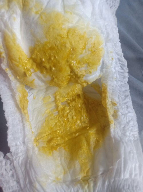 น้องถ่ายเหลว ถ่ายแบบนี้มาสามสี่วันแล้ว แต่น้องไม่มีอาการอื่น ยังดื่มนมปกติ น้องดื่มนมผงอยู่