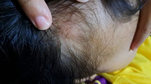 Benjolan di kepala tidak sakit