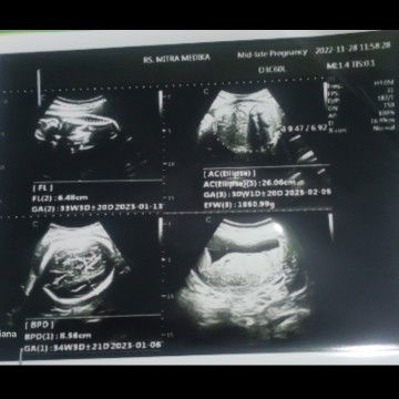 Jk bayi bisa berubah atau meleset