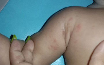 ผื่นแพ้ แพ้นม