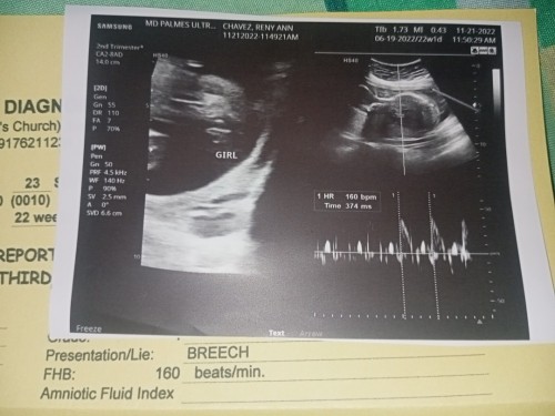 Sabi sakin ng ob 80% girl daw si baby 22 weeks ultrasound po yan, nka breech presentation