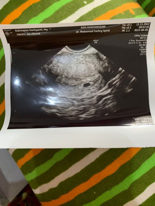 Hasil USG usia Kandungan berbeda