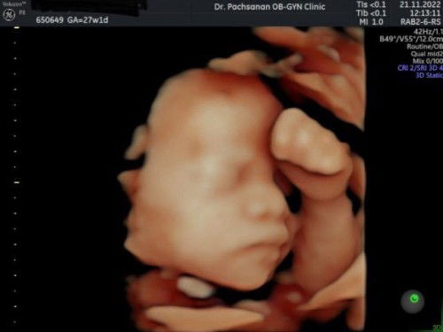 28 สัปดาห์ แล้วตอนนี้ ปัญหาบ้านนี้คือ 
ลูกชอบดิ้นด้านซ้าย นอนตะแคงซ้ายไม่ได้เลย กลัวลูกอึดอัด