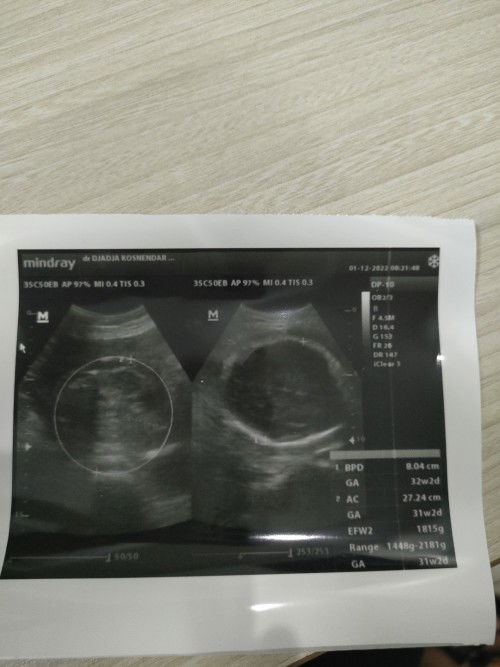 Usg kehamilan