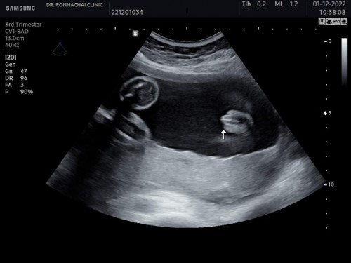 28วีค+3วัน