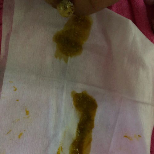 Em bé 20 ngày tuổi