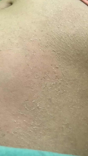 hamil 2 bulan kulit perut mengelupas