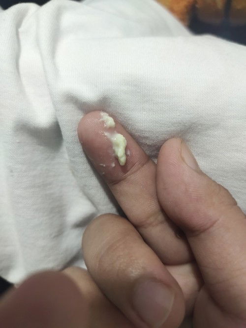 FTM, yeast infection po ba to? Wala po syang amoy and hindi rin po siya makati. 

Thank you po