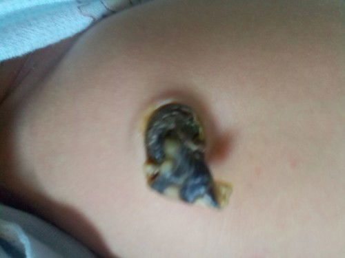 สะดือแบบนี้ผิดปกติมั้ย