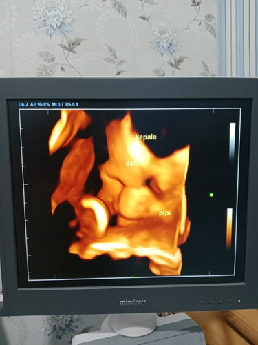 38weeks3day hpl 13Desm