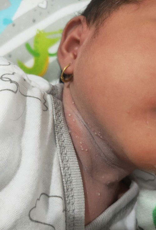 Leher merah dan muncul seperti jerawat