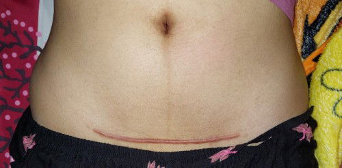 Bisakah keloid kempes?,