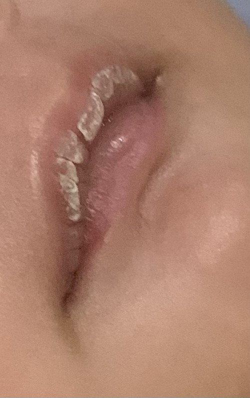 Bibir atas kering putih